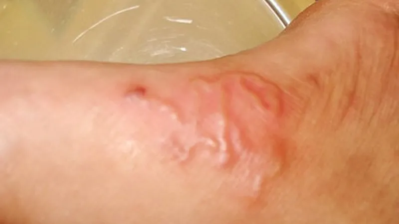 Sán chó thâm nhập và kỳ sinh trùng trong da người