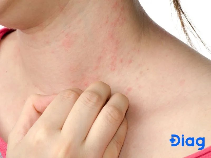 Cần thăm khám y tế sớm nếu tình trạng dị ứng gây khó thở hoặc mệt mỏi kéo dài