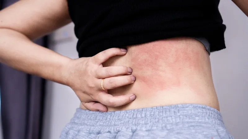 Triệu chứng nhiễm giun sán chó mèo thường biểu hiện qua ngứa và phát ban trên da