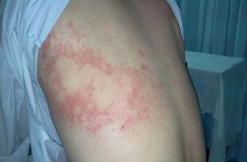 Dấu hiệu nhiễm sán chó ở người với đặc điểm da nổi mề đay